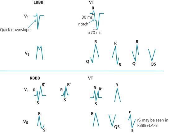 Figure 7. Differences in morphology between SVT with aberrancy and VT. SVT with aberrancy has a typical LBBB or RBBB morphology. Conversely, VT is suggested by: - LBBB with a wide initial R wave >30 ms, R‐to‐nadir of S >70 ms, or notched S descent in V 1 ; or Q wave in V 6 .
- RBBB with a wide R pattern in V 1 instead of RSR', R >R’ in V 1 , or monophasic R or QS in V 6 . RBBB with a left axis or with a rS pattern in V 6 does not necessarily imply VT (could be RBBB + LAFB). While rS pattern in V 6 is not typical of LBBB or RBBB, it may be seen with atypical LBBB (enlarged LV) or RBBB + LAFB. Deep Q in V 6 (QS or Qr) implies VT. Left QRS axis may be seen with LBBB or RBBB + LAFB. Right QRS axis, on the other hand, is not typically seen with either LBBB or RBBB and usually implies VT.