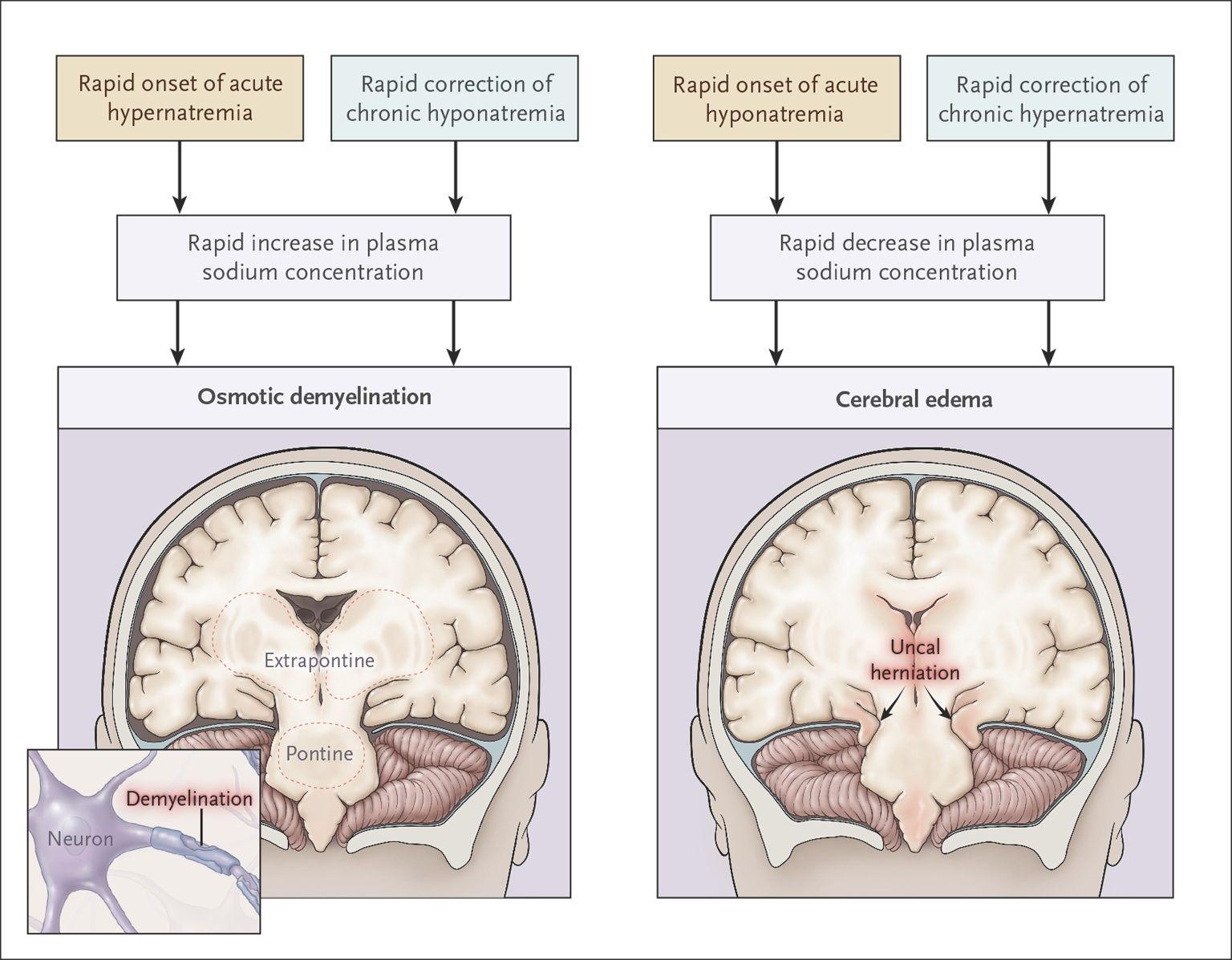 Consequences of Rapid Changes in the Plasma Sodium Concentration.