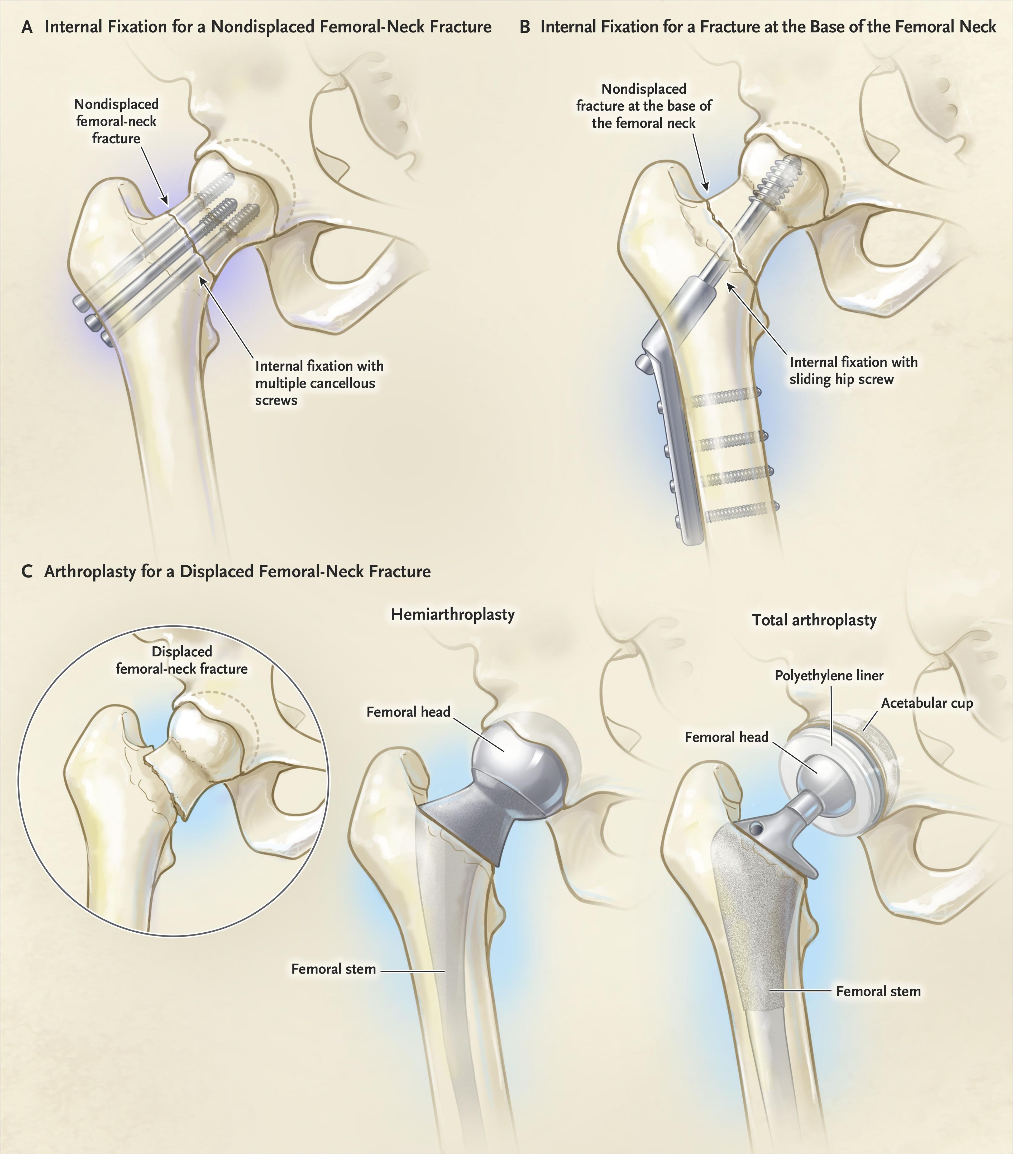 Selected Treatments for Hip Fracture.