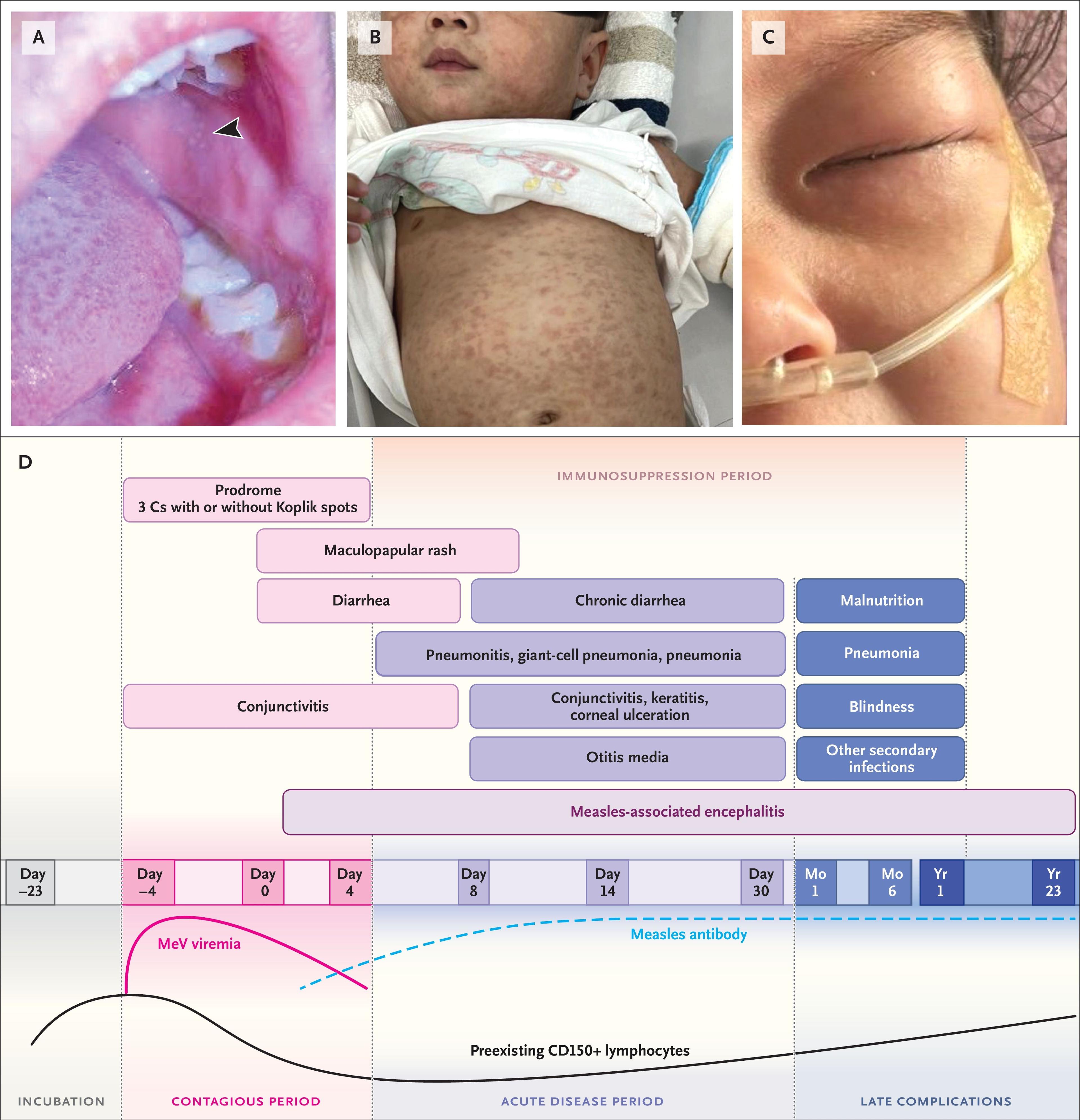 Clinical Features and Pathogenesis of Measles.