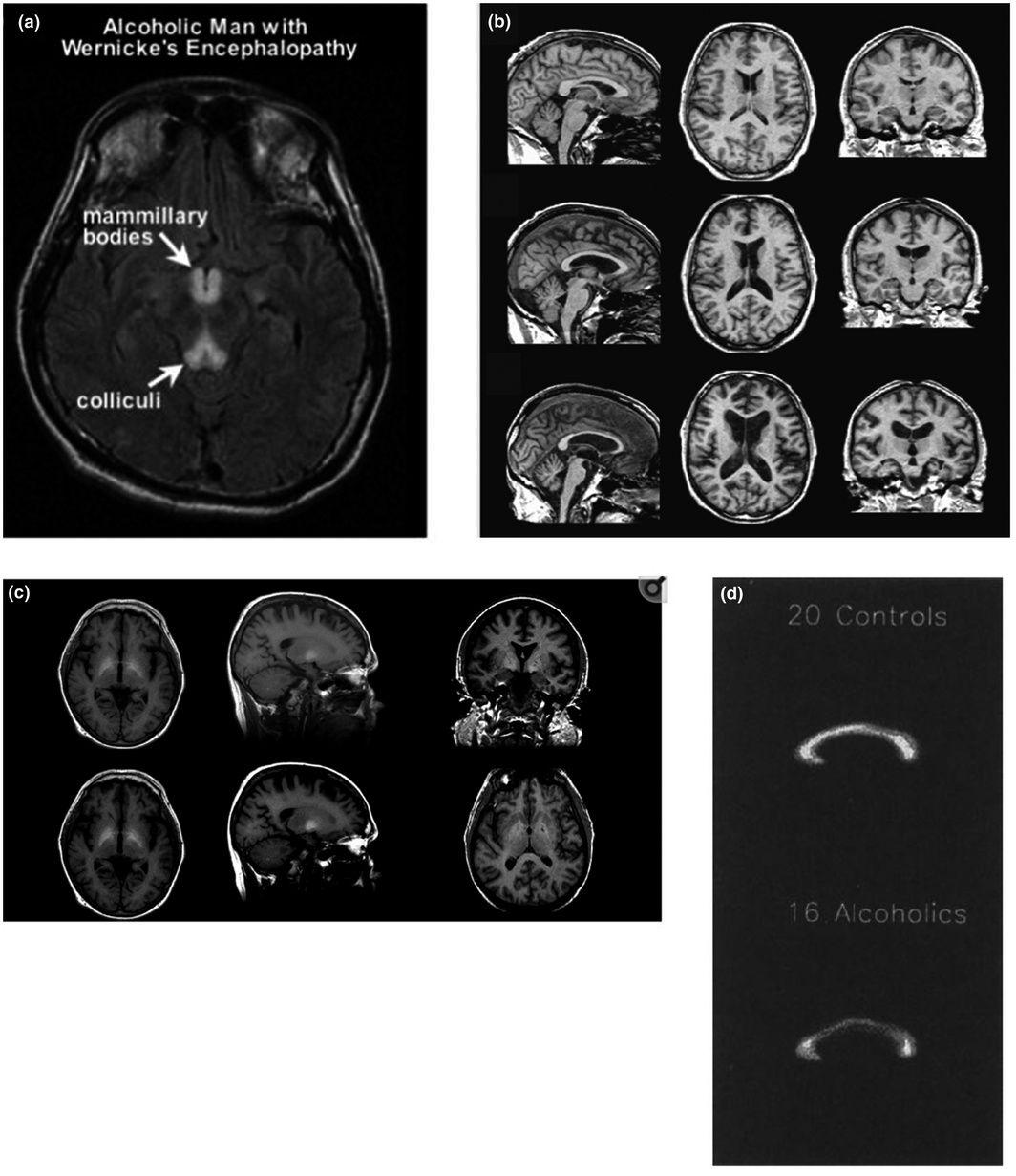 (a) Brain image of an alcoholic man with Wernicke’s encephalopathy showing hypertensities in mammilary bodies and colliculi (reprint with permission from (Sullivan & Zahr, 2008 )).