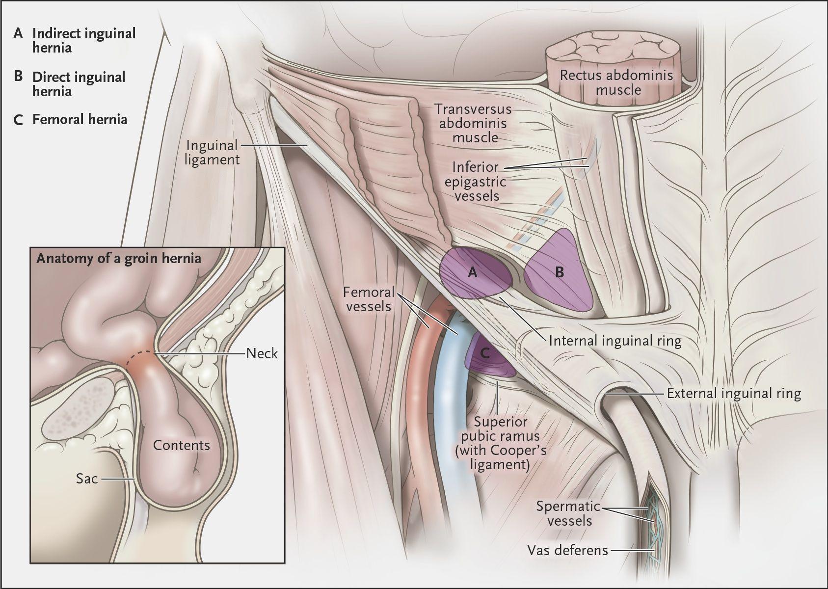 Types of Hernia and Hernia Anatomy from an Anterior Perspective.