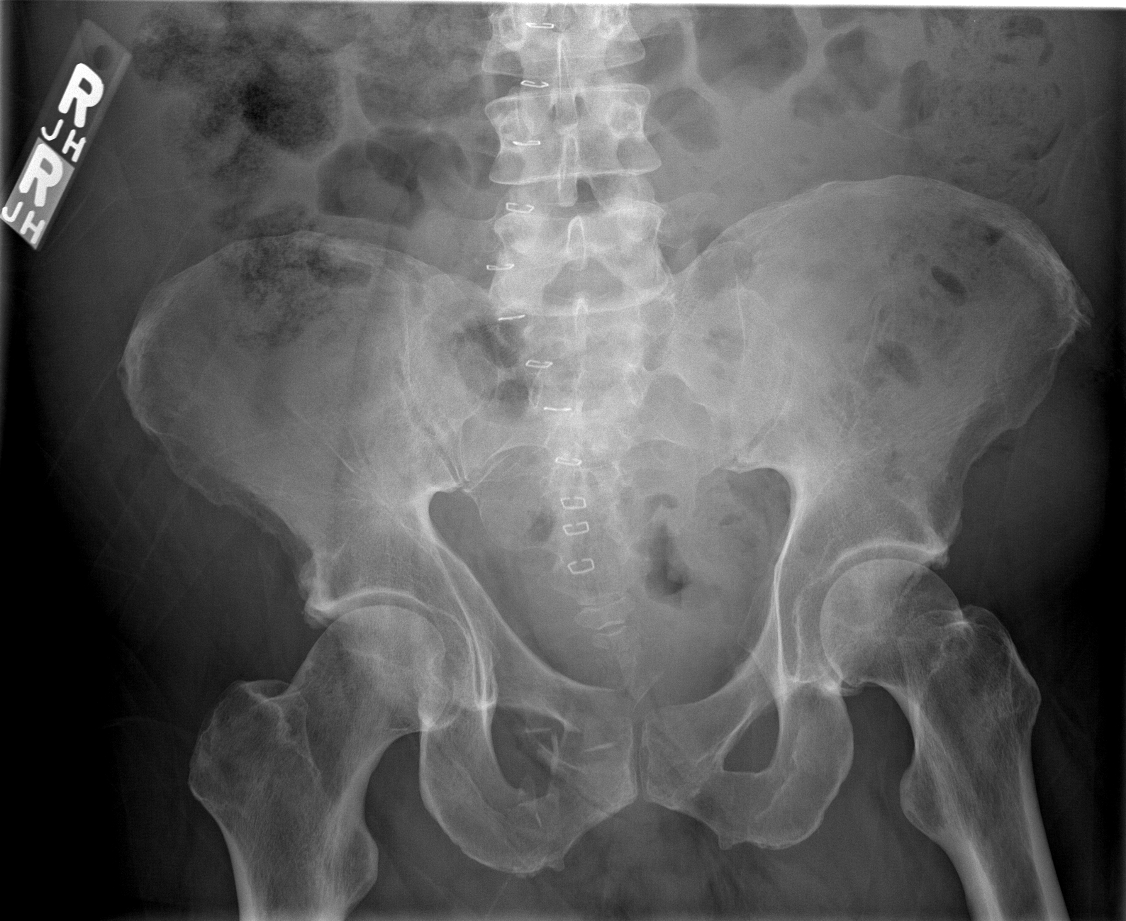 Comminuted fractures of the superior and inferior pubic rami with offset of the pubic symphysis.