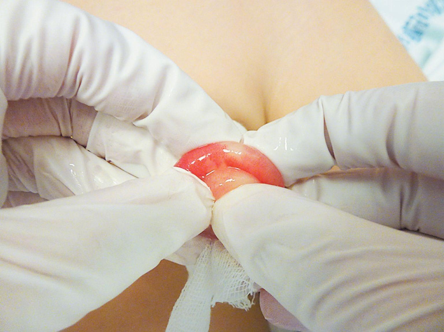 Reduction of a Paraphimosis.