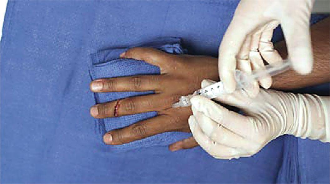 Injection of a Digital Nerve Block.