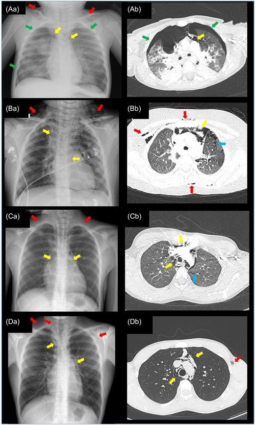 Radiological findings in the four children diagnosed with pneumomediastinum during a SARS‐CoV‐2 infection.