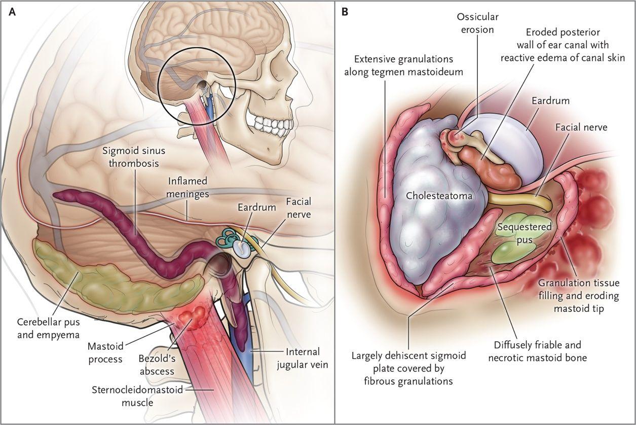 Schematic Representations of the Spread of Infection from Otitis Media (Panel A) and Operative Findings (Panel B).
