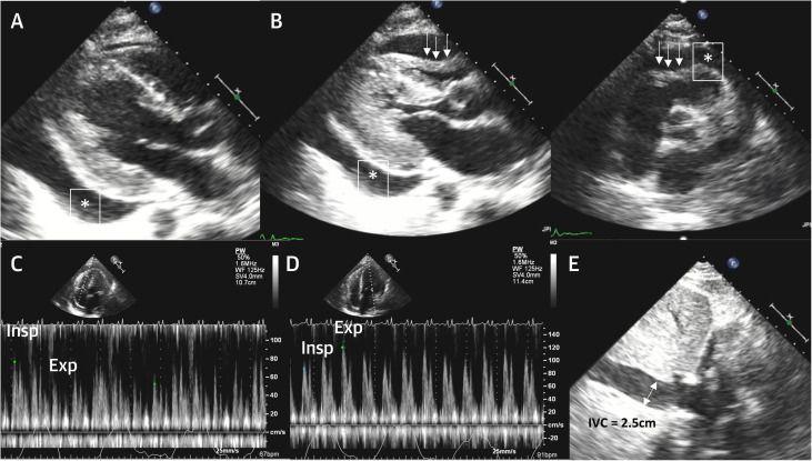 TTE Signs of CTP