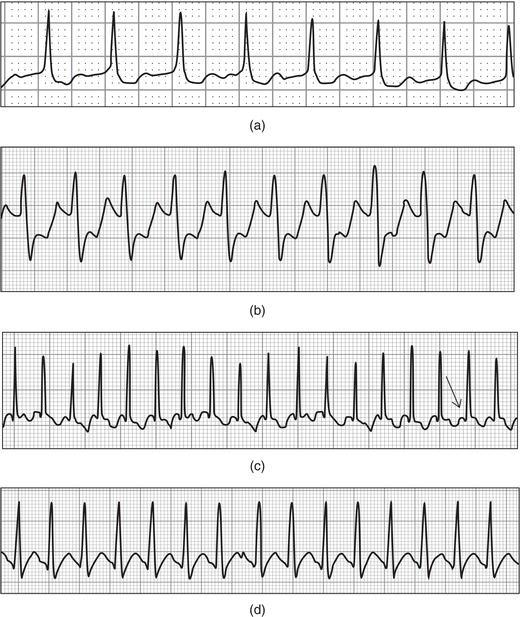 Paroxysmal supraventricular tachycardia ( PSVT ). (a) PSVT with a relatively slower rate of approximately 150 bpm. (b) PSVT at approximately 170 bpm; the ST segment depression is likely a rate‐related phenomenon and not indicative of coronary ischemia. (c) PSVT in a neonate with an approximate rate of 260 bpm; note the retrograde P wave (arrow) preceding the QRS complex. (d) PSVT in the Wolff–Parkinson–White syndrome. Other than a more rapid rate, this form of PSVT is indistinguishable from non‐WPW‐related PSVT.