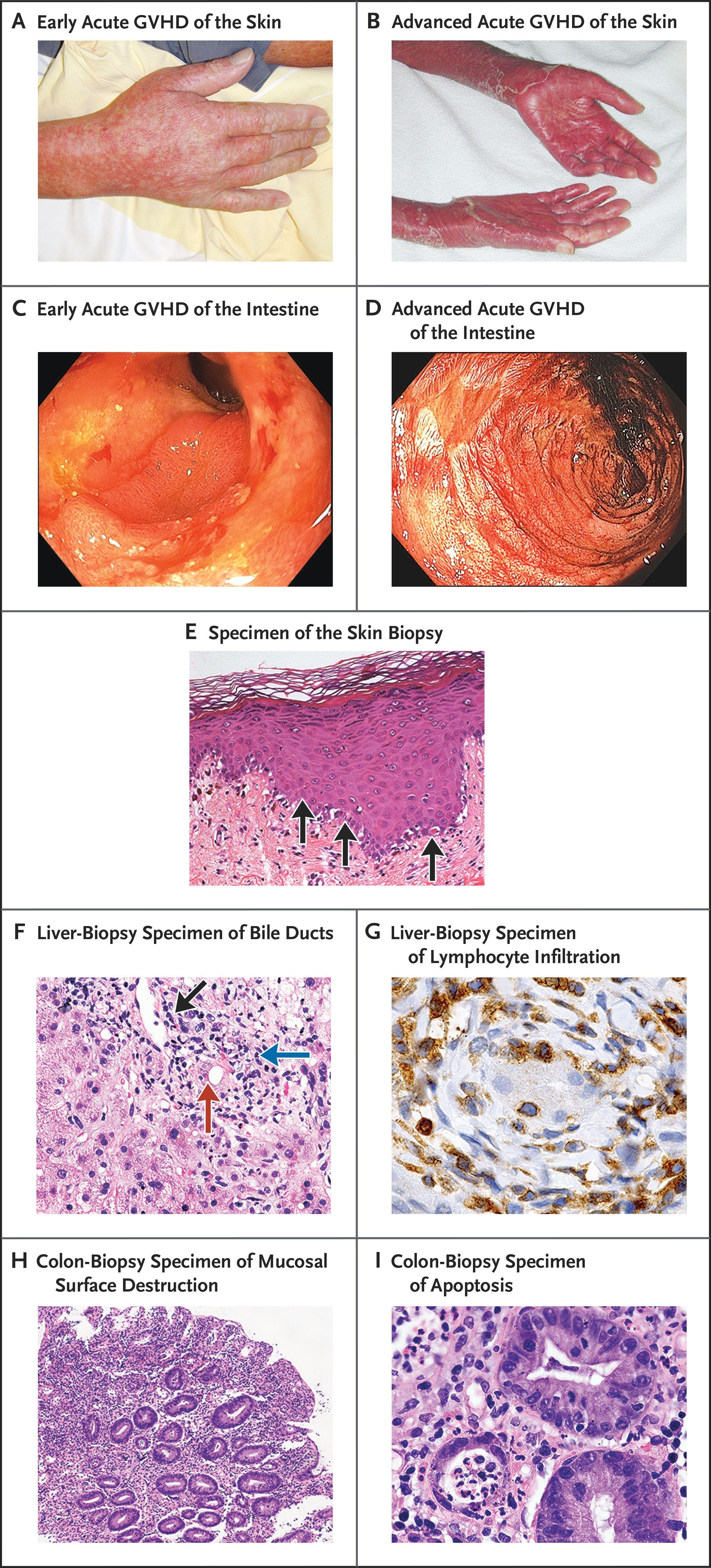 Clinical Features of Acute GVHD.
