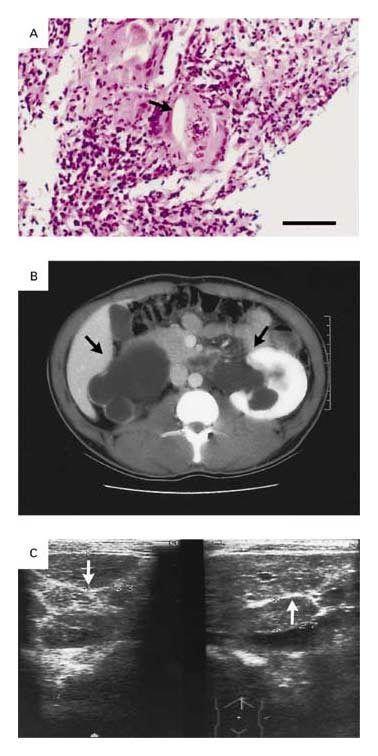 Clinical Findings in Two Patients Infected with Schistosoma Species.