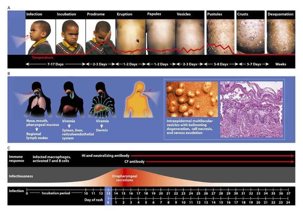 Clinical Manifestations and Pathogenesis of Smallpox and the Immune Response.