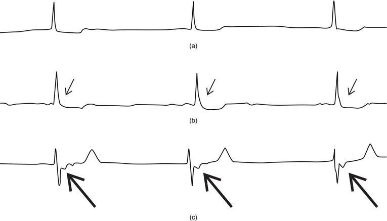 Junctional rhythm. (a) Junctional rhythm with no evident P wave; the rhythm is regular with a narrow QRS complex. (b) Junctional rhythm with a P wave “buried” in the terminal portion of the QRS complex (small arrow). (c) Junctional rhythm with an inverted P wave, which is evident after the QRS complex (long arrow).