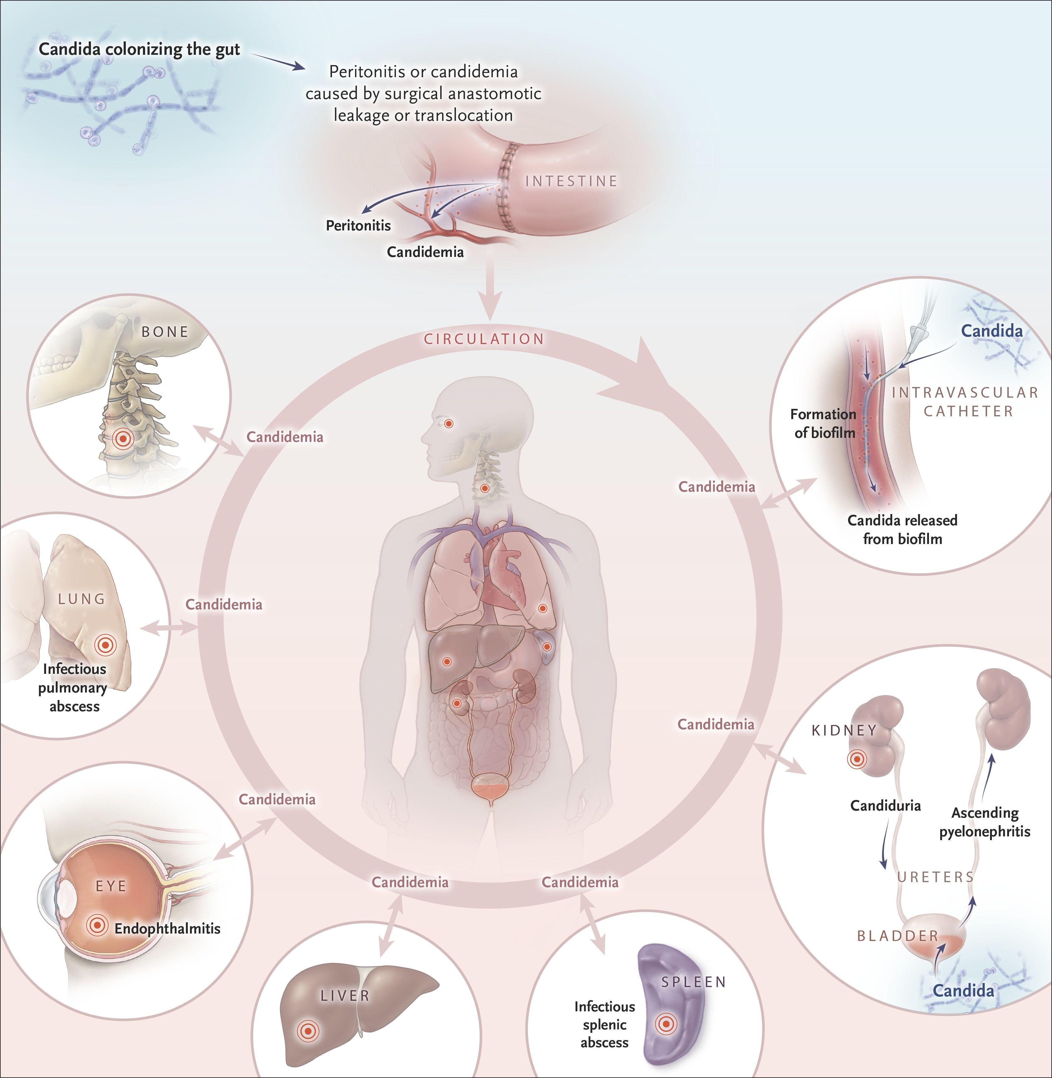 Pathogenesis of Invasive Candidiasis.