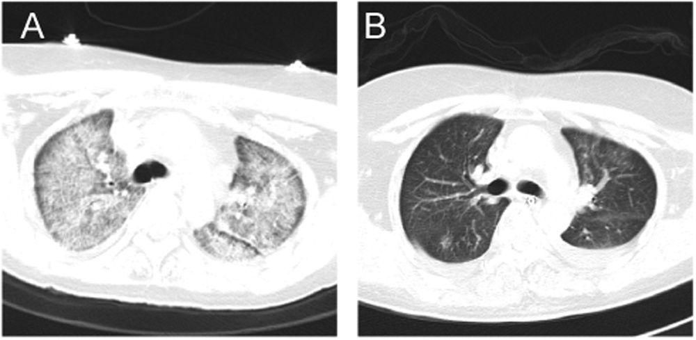 Chest CT results of patient 7 after admission.