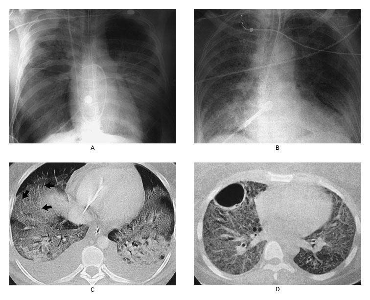 Radiographic and Computed Tomographic (CT) Findings in the Acute, or Exudative, Phase (Panels A and C) and the Fibrosing-Alveolitis Phase (Panels B and D) of Acute Lung Injury and the Acute Respiratory Distress Syndrome.