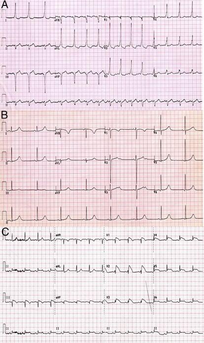 Electrocardiographic Patterns Observed in Electrical Cardiac Abnormalities Associated With Sudden Cardiac Death