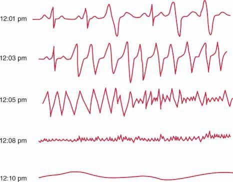 Figure 5. A typical sequence of events in sudden death. This figure shows tracings from a Holter recording made in a patient who experienced sudden death. At 12.01 p.m. the patient is in sinus rhythm with PVCs. At 12.03 p.m. ventricular tachycardia occurs, which degenerates to ventricular fibrillation at 12.05 p.m. By 12.08 p.m., fine ventricular fibrillation is present. All electrical activity has ceased by 12.10 p.m.