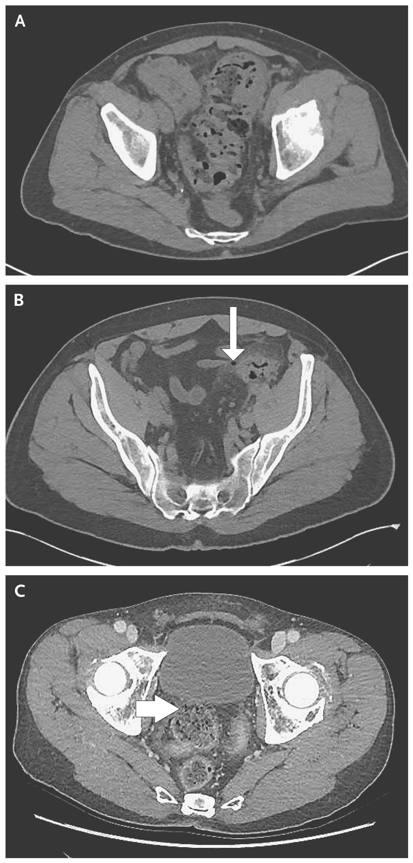 CT Images of the Colon in Patients with Diverticulitis.