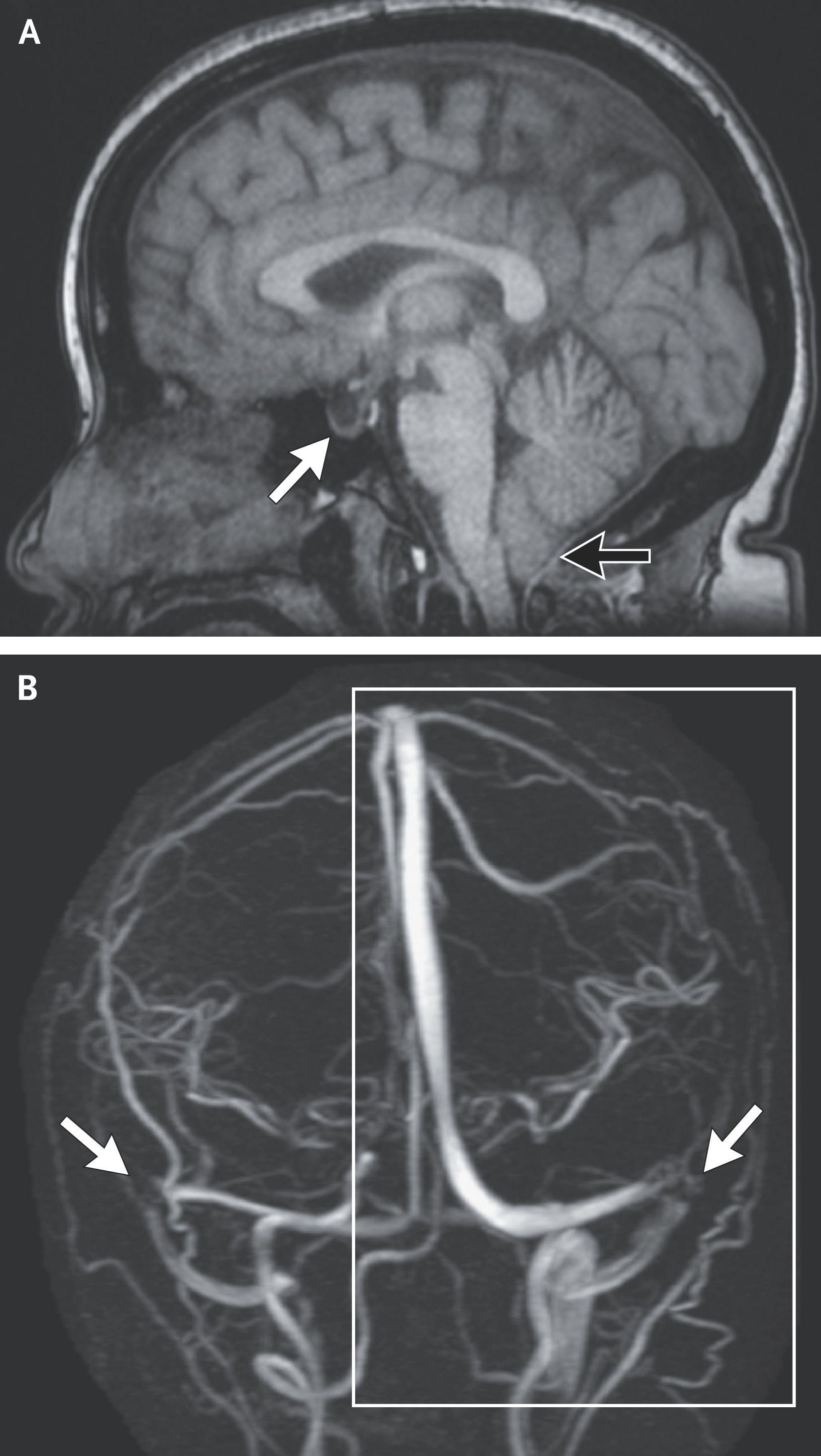 MRI Scans in Idiopathic Intracranial Hypertension.