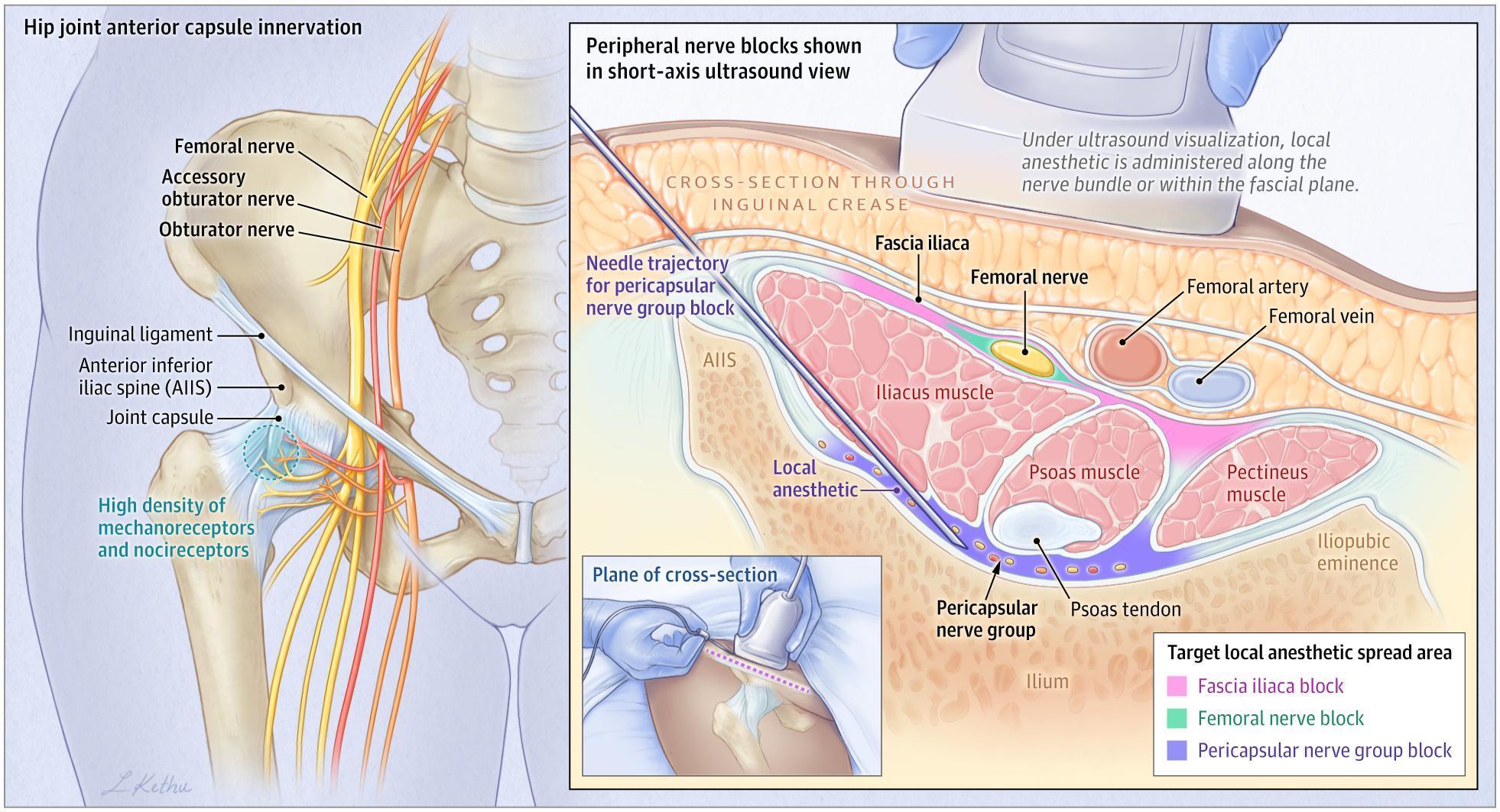 Common Hip Fracture Nerve Blocks and Ultrasound Anatomy