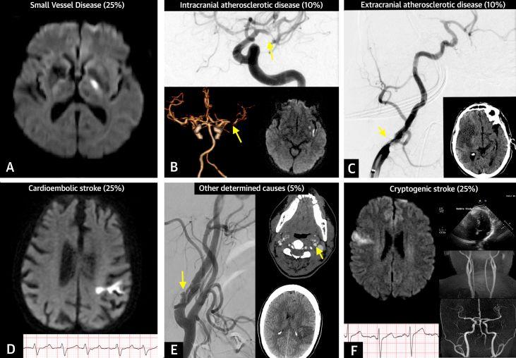 Prevalence of Stroke Subtypes