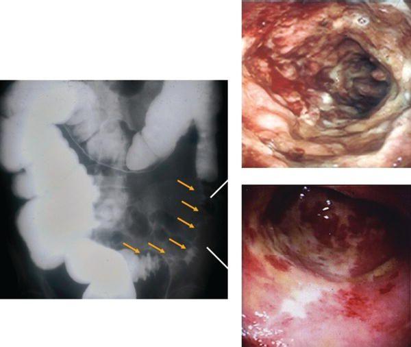 Segmental ischemic colitis in an elderly man resembling Crohn’s disease. Note the thumbprinting appearance on the barium enema (left) that corresponds to a nonspecific cobblestone, ulcerated and hemorrhagic colonoscopic pattern (right). Source: Courtesy of Lawrence J. Brandt, Montefiore Medical Center, New York.