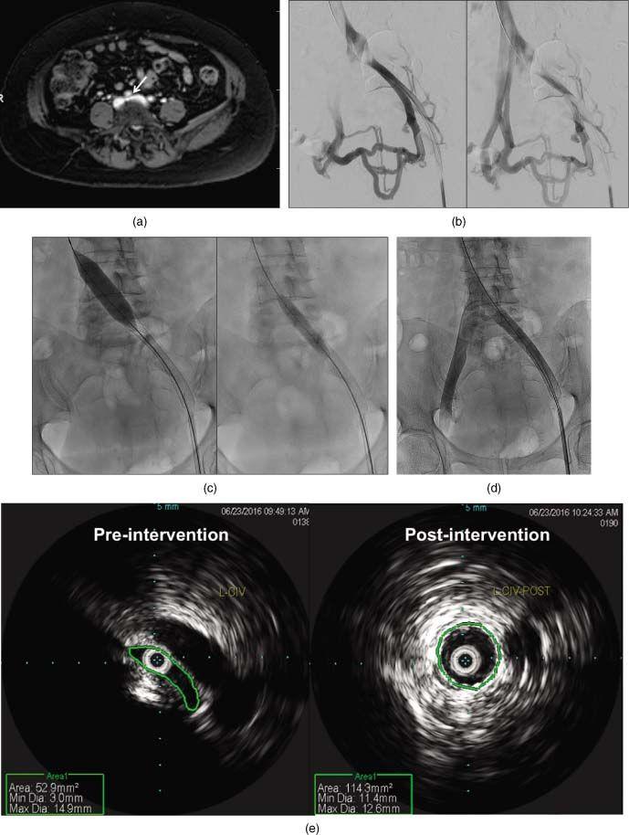 (a) MR venography showing the right common iliac artery compressing the left common iliac vein (arrow). (b) Venogram showing patency distal to the focal compression of the left common iliac vein. Retrograde flow is seen through the left hypogastric vein, which supplies multiple left‐to‐right pelvic collaterals that eventually drain into the IVC. (c) The left common iliac vein and left external iliac vein stenosis were stented using a 16 mm × 90 mm Wallstent. The Wallstent was then post dilated proximally to 16 mm and distally to 12 mm. (d) Post‐intervention venogram showing marked improvement in the diameter of the lumen and resolution of the collateral veins previously seen. (e) Marked improvement in luminal area of the left common iliac vein by IVUS (53 mm 2 pre‐intervention to 114.3 mm 2 post‐intervention).