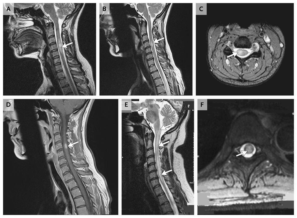 Features of Common Myelitis Syndromes on Neuroimaging.