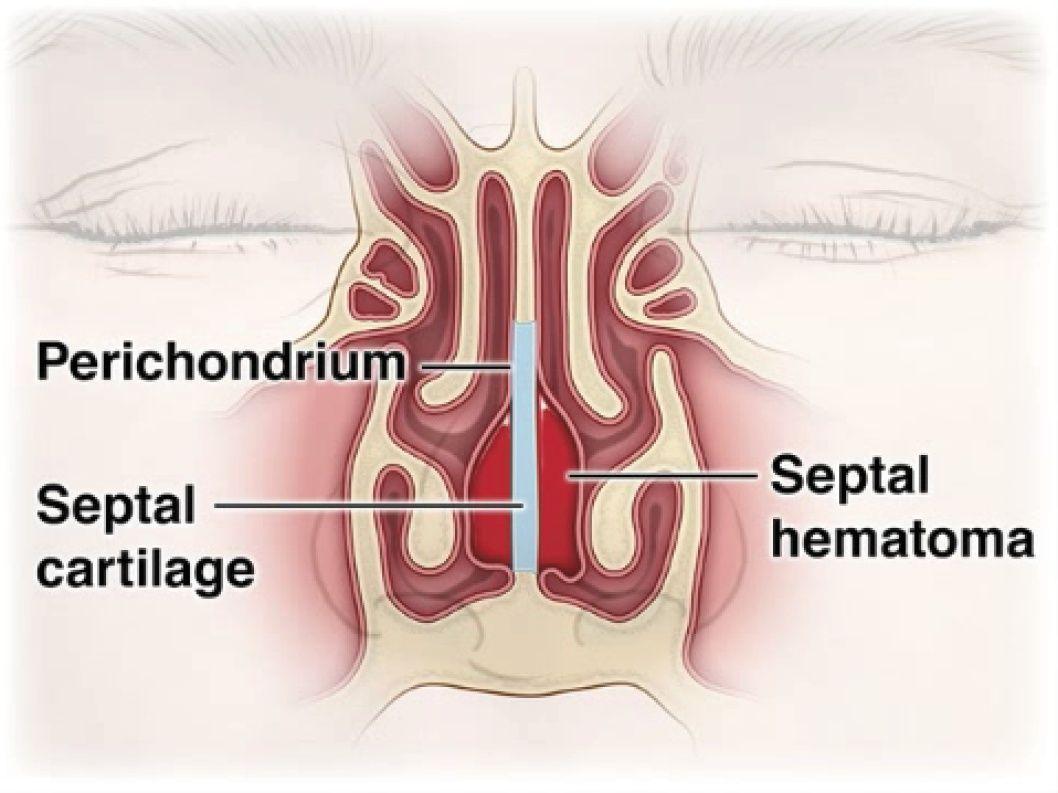 Coronal Cross Section of the Cartilaginous Portion of the Nasal Septum.