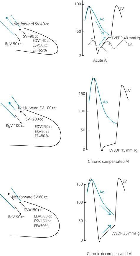 1. In acute AI, LV volume is normal and the regurgitant volume leads to a severe increase in LVEDP. The LV and aortic pressures approximate in end‐diastole forming a diastolic triangle ( blue arrows ) (∆<30 mmHg or <25% of SBP). LV diastolic pressure exceeds LA pressure in mid or late diastole ( gray arrow ). 2. In chronic AI, LV volume increases and the total stroke volume increases, thus leading to a high pulse pressure, and the forward stroke volume is maintained. The LV is large and compliant in a way that it accommodates the regurgitant volume without an increase in LVEDP. 3. In chronic decompensated AI, the LV function starts to be impaired, EF is reduced in a way that the forward stroke volume is reduced, and the LV volume increases, leading to increased LVEDP. Total stroke volume remains elevated, and thus, the pulse pressure remains elevated. Note the attenuation or loss of the dicrotic notch, especially in acute AI . In chronic AI, the aorta may improve its compliance, causing the dicrotic notch to re‐emerge. EDV, end‐diastolic volume; EF, ejection fraction; ESV, end‐systolic volume; RgV, regurgitant volume; SV, stroke volume. Reproduced with permission from Hanna EB. Aortic regurgitation. In: Hanna EB, Glancy DL. Practical Cardiovascular Hemodynamics. New York, NY: Demos Medical, 2012, p. 115.