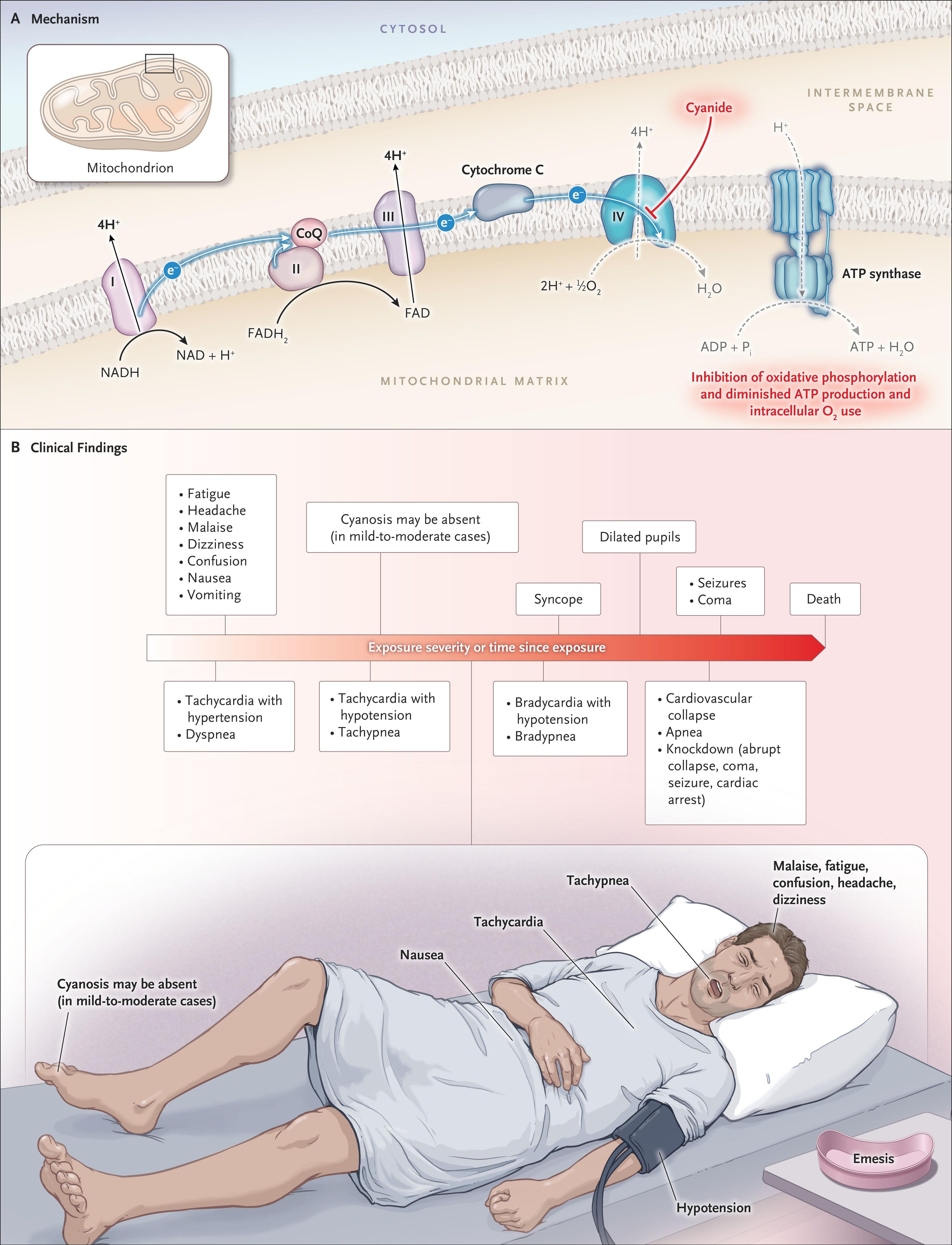 Cyanide Poisoning.