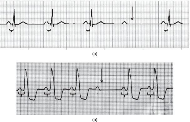 Second‐degree type II AV block type (Mobitz II). Note the consistent PR interval (braces) followed by an orphan P wave and resultant dropped QRS complex (arrow). (a) Narrow QRS complex; (b) wide QRS complex.