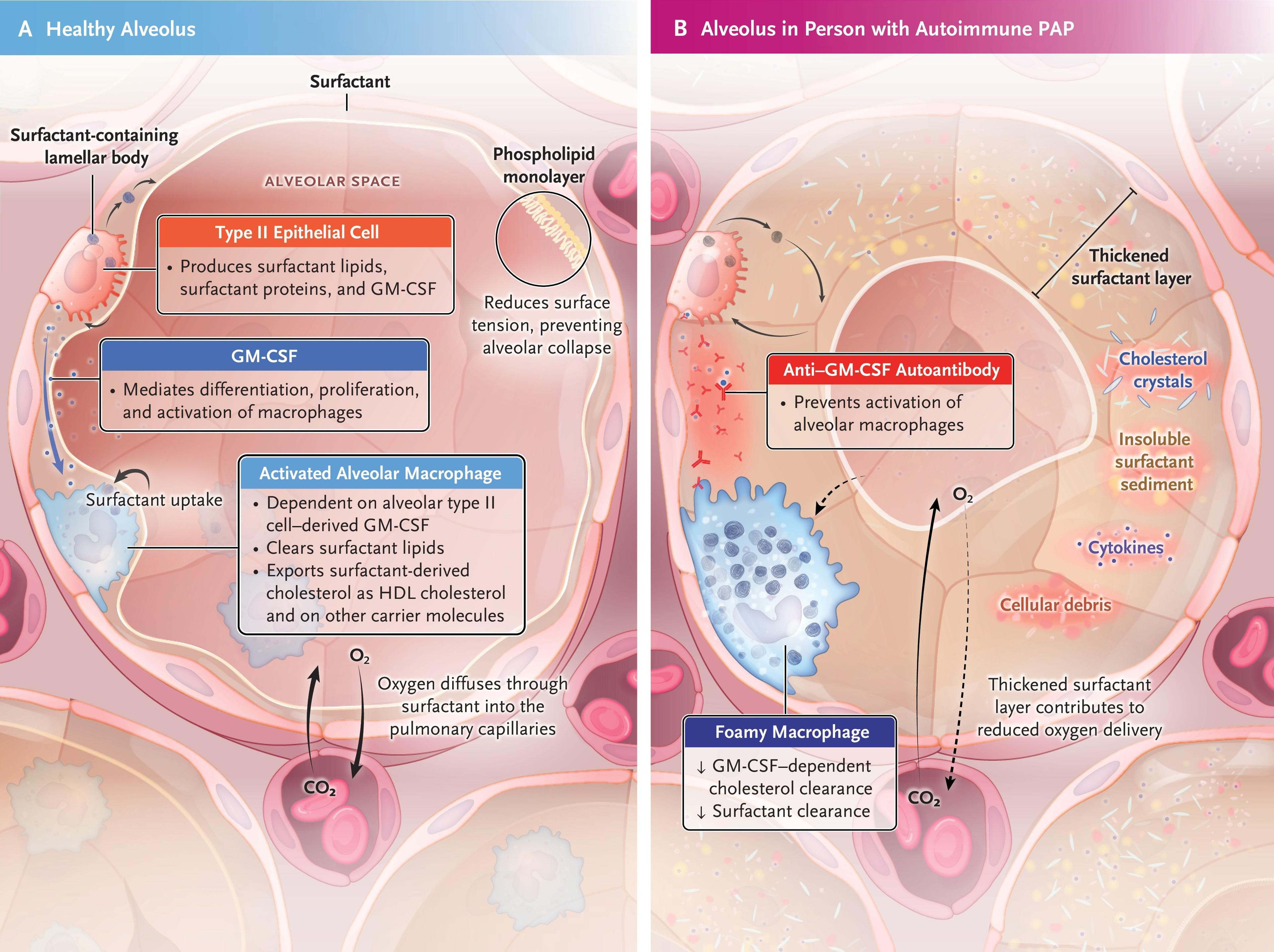 The Alveolus and Autoimmune Pulmonary Alveolar Proteinosis (PAP).