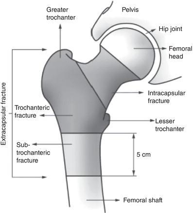 Classification of hip fractures by Parker and Johansen. Source: Parker and Johansen , © 2006 BMJ Publishing Group Ltd.