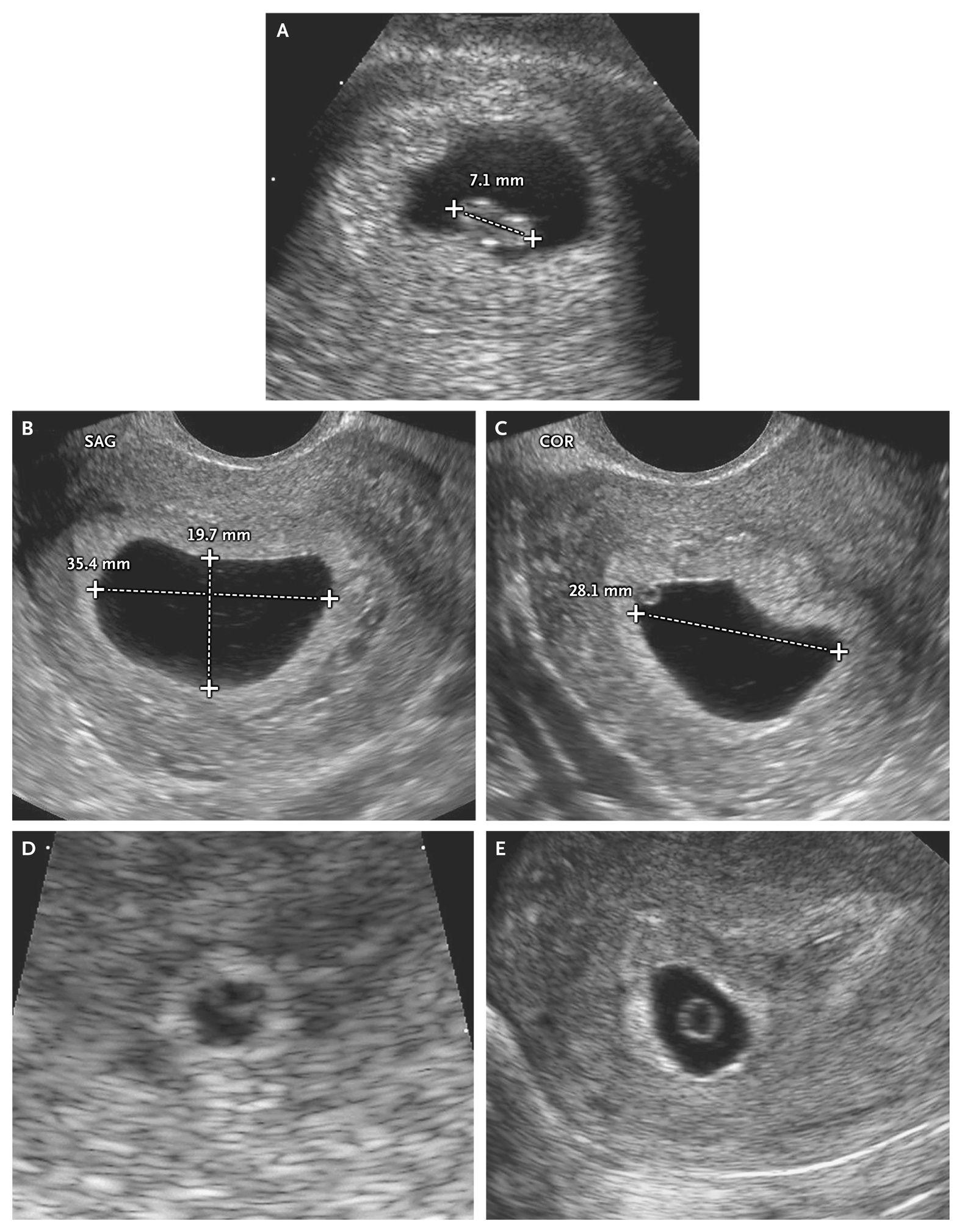 Definite Pregnancy Failure Diagnosed in Three Women by Means of Transvaginal Ultrasonography.