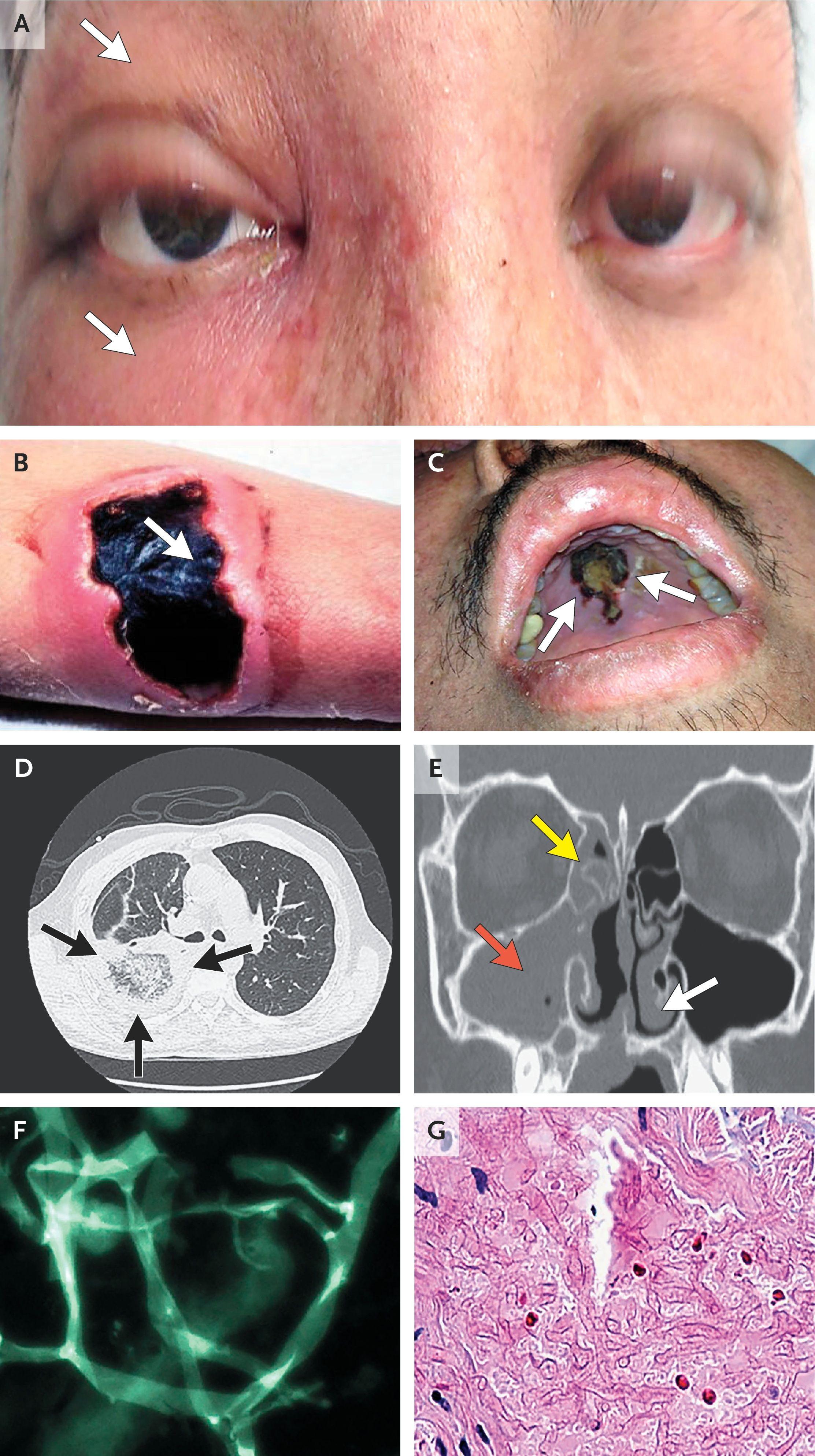 Direct Examination and CT Imaging in Mucormycosis.
