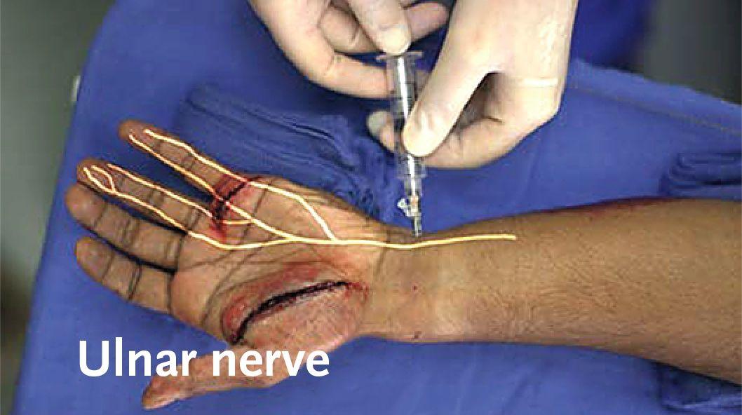 Ulnar Nerve Block.