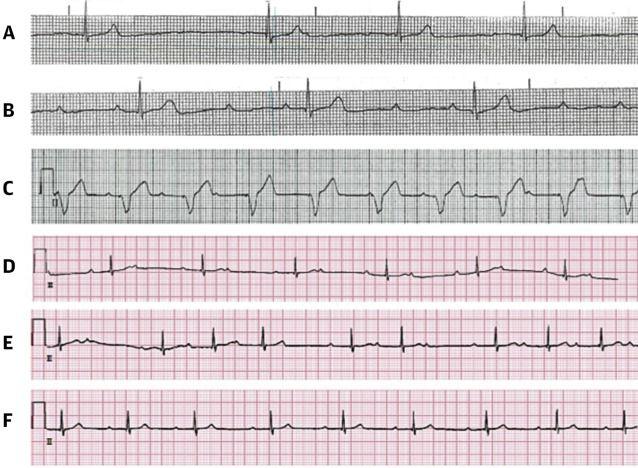 The Electrocardiographic Progression of a Patient With LC Presenting With High-Degree AVB