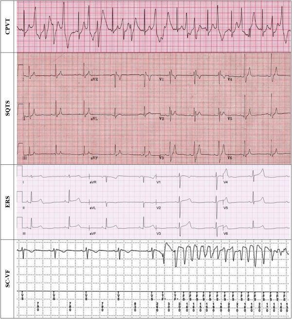 Figure 2. ECG Examples of “Latent” Cardiac Arrest Conditions