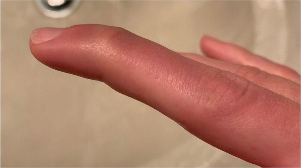 Acute mallet finger injury.