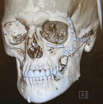 Figure 28. Postoperative 3D reconstruction demonstrating adequate reduction and plating of the zygomaticomaxillary complex and arch fractures.