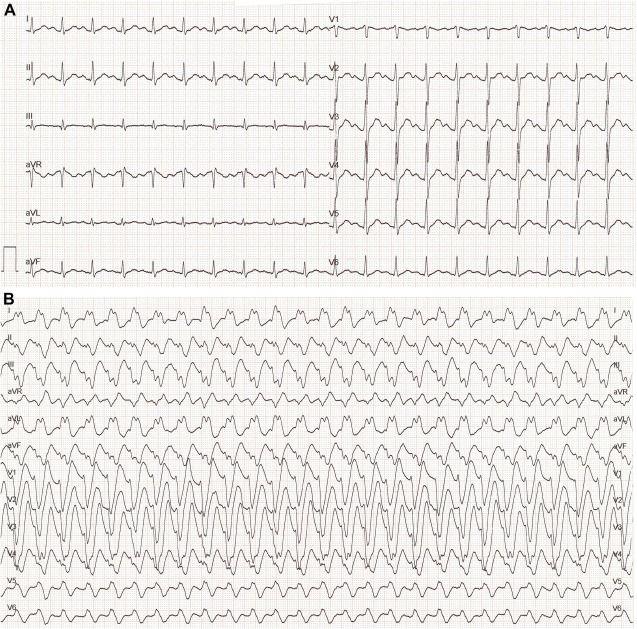 Electrophysiological Evolution of the Na+ Channel Blocking Effect Induced by Cocaine Intoxication