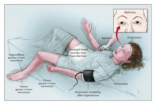 Findings in a Patient with Moderately Severe Serotonin Syndrome.