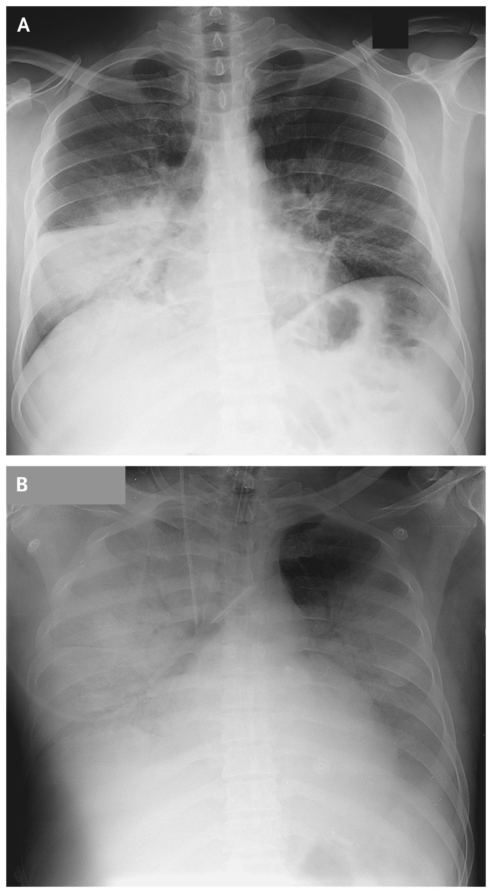 Progressive Worsening of Infection in Patient 2.