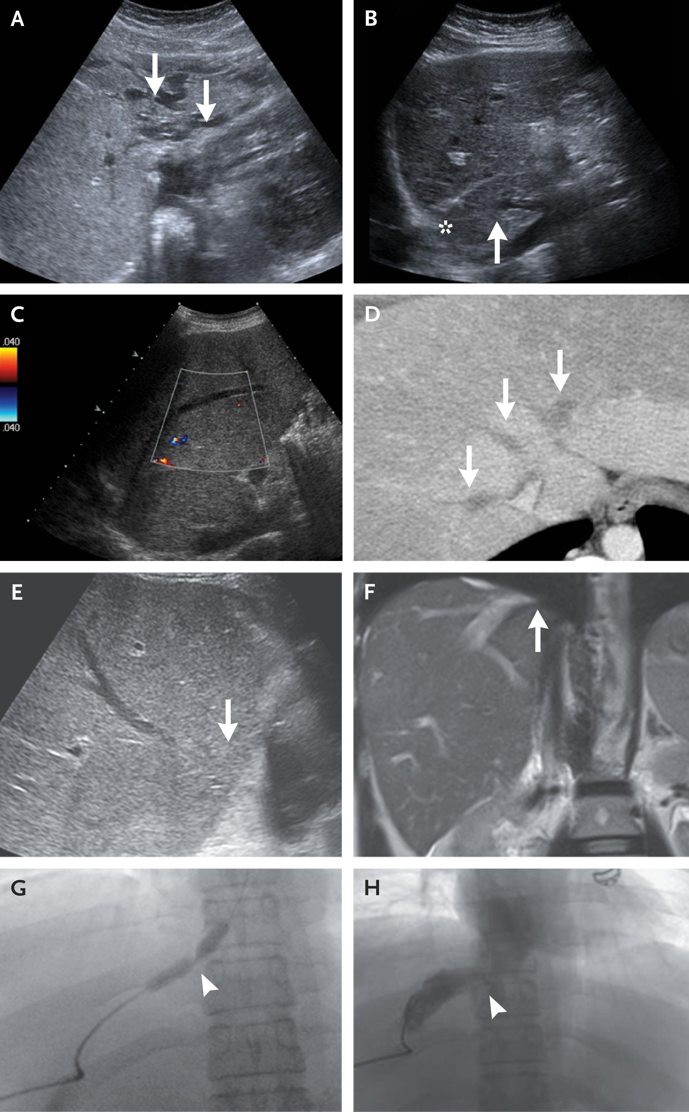 Imaging Features of Budd–Chiari Syndrome.