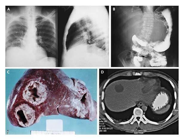 Radiographic and Pathological Features of Extraintestinal Amebiasis.
