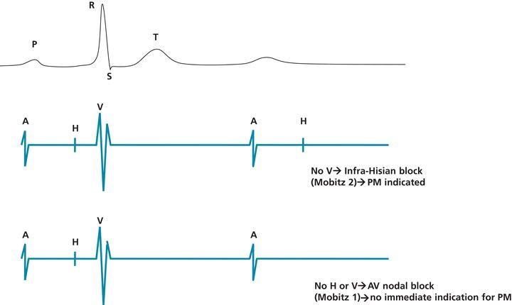 Types of AV block.
